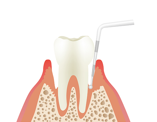 歯周病（歯ぐき）の検査・応急処置