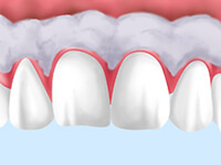歯ぐきの黒ずみが気になる方に