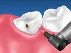 マイクロスコープを使用した虫歯治療