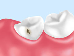 虫歯は進行しやすい病気です