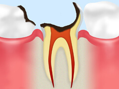 C4　歯の根の虫歯