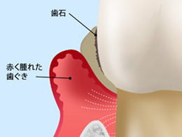 歯周ポケットとは