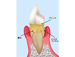 歯周ポケットとは