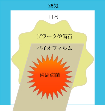 歯周病菌たちはこのような棲み家を作っている！