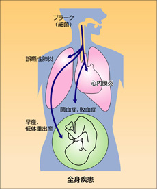 全身の健康のためにお口の中の健康を