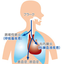 誤嚥性肺炎とは